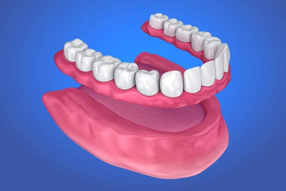 Dentures being overlaid