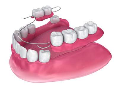 Partial dentures being laid down next to teeth